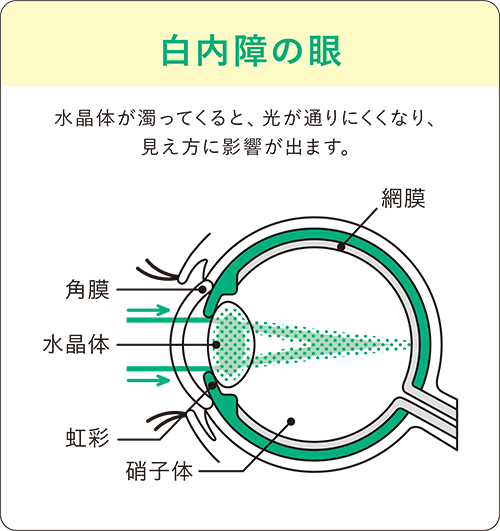 正常な目：水晶体が濁ってくると、光が通りにくくなり、見え方に影響が出ます