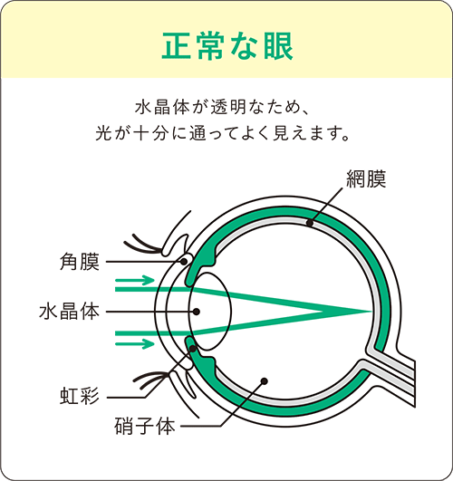 白内障の目：水晶体が透明なため光が十分にとおってよく見えます