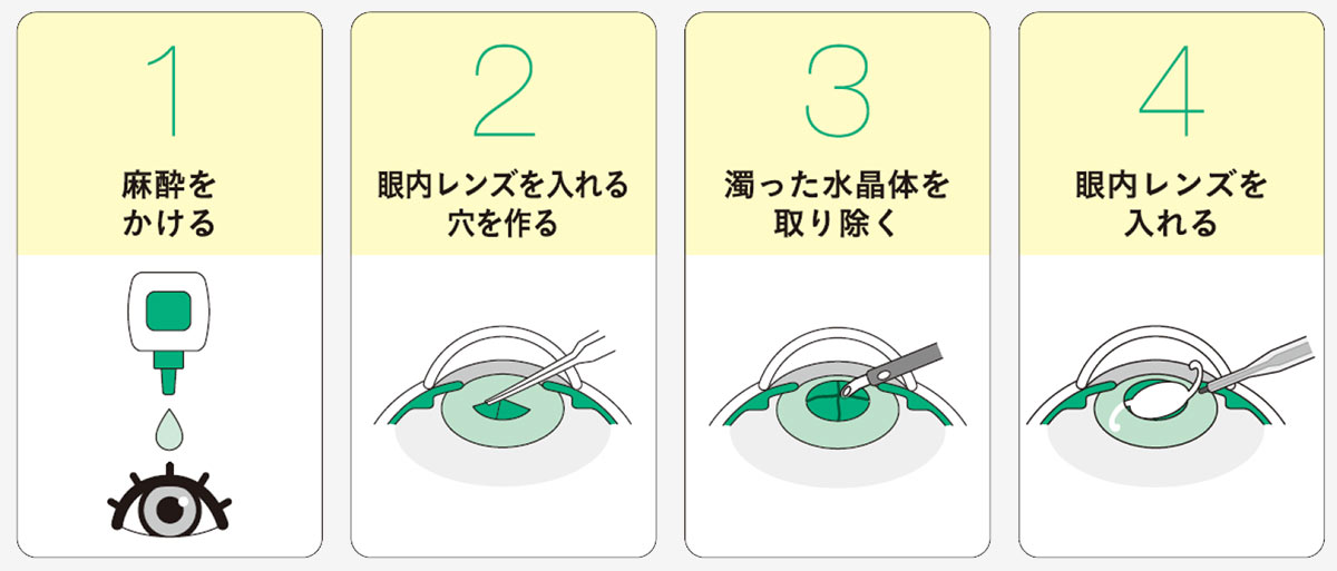 手術の流れ