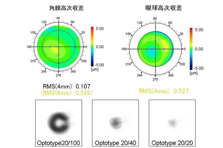 高次収差による不正乱視の状態