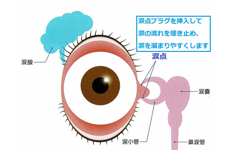 涙点プラグを挿入することにより涙の流れを堰き止めて目に涙が溜まるようにします