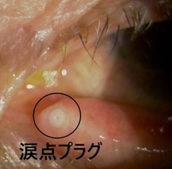 左下まぶたの涙点に涙点プラグを挿入した状態、涙の流れをせき止めて、目に溜まる涙の量を増やします