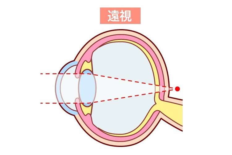 遠視