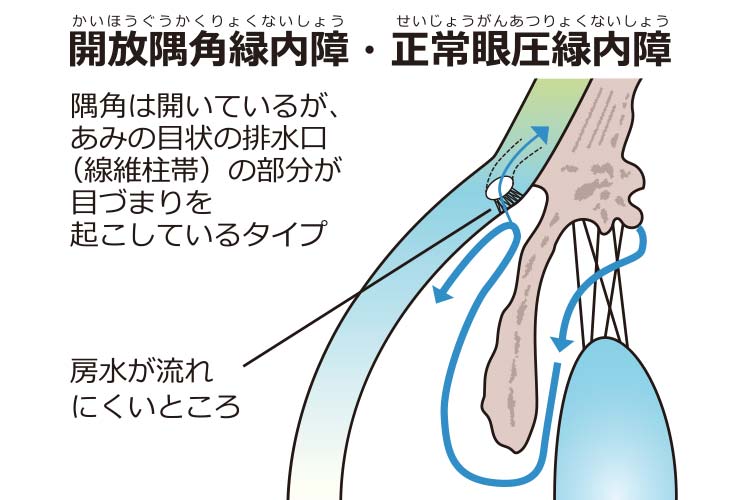 開放隅角緑内障