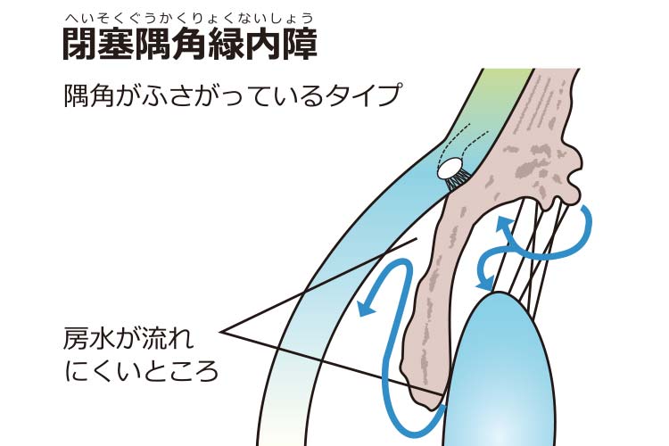 閉塞隅角緑内障