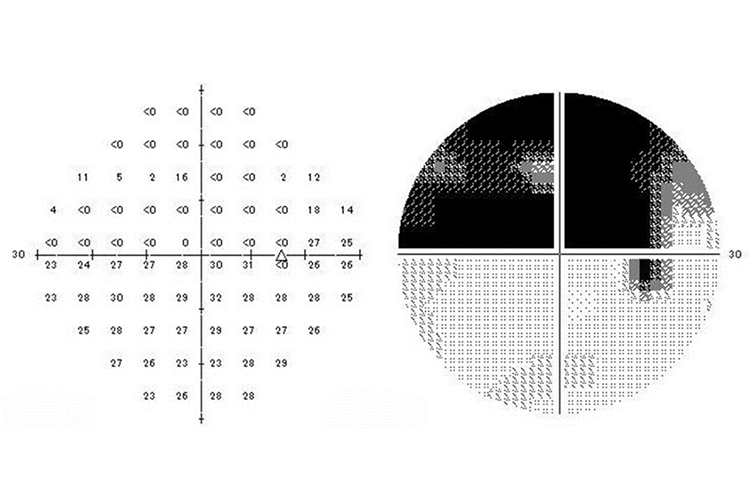 視野検査結果例 右眼