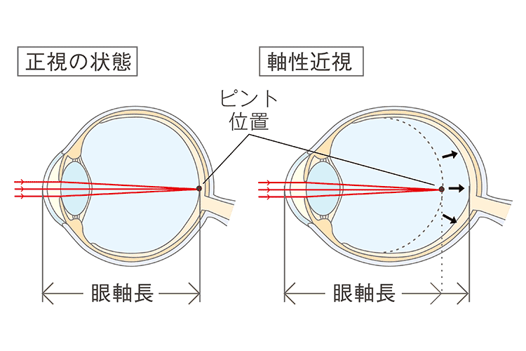 眼球断面図 軸性近視