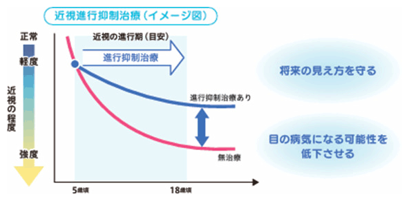 近視進行抑制治療(イメージ図)