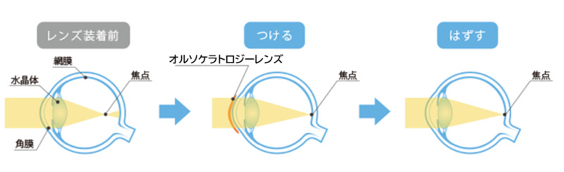 オルソケラトロジーとはイメージ画像