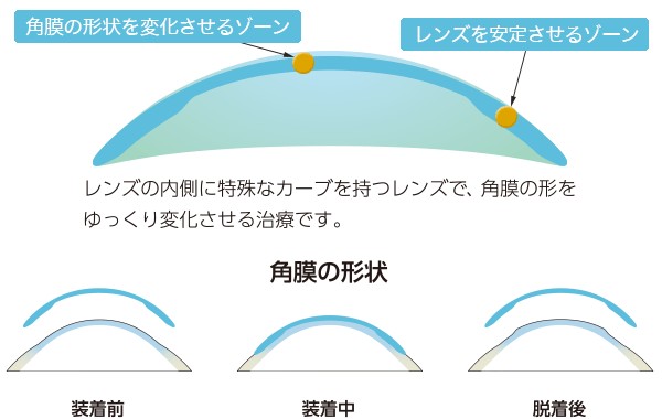 特殊なレンズデザインが角膜の形状を矯正とはイメージ画像