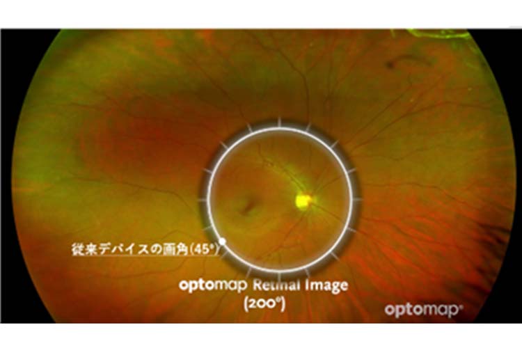 広角眼底カメラでの撮影範囲