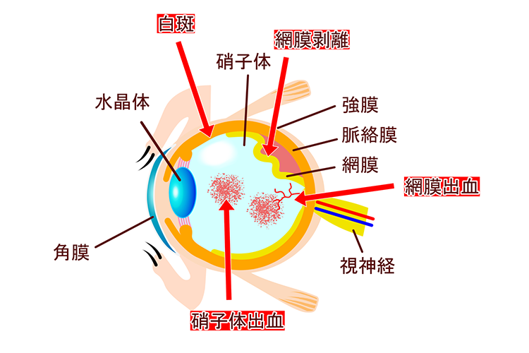 糖尿病網膜症イメージ画像